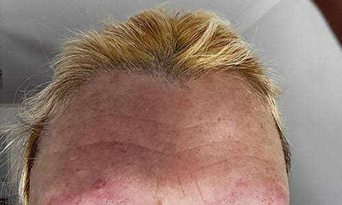 collagen supplements before and after